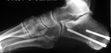 Profil radiologic postoperator osteortomie de calcaneu