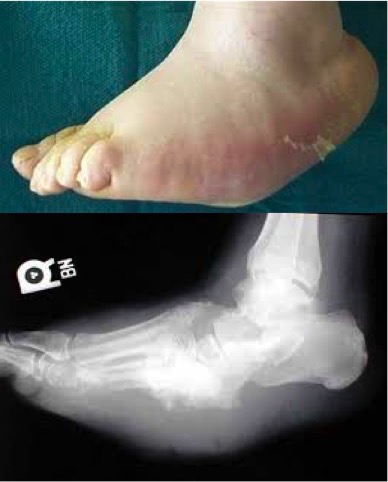 Picior Diabetic Charcot